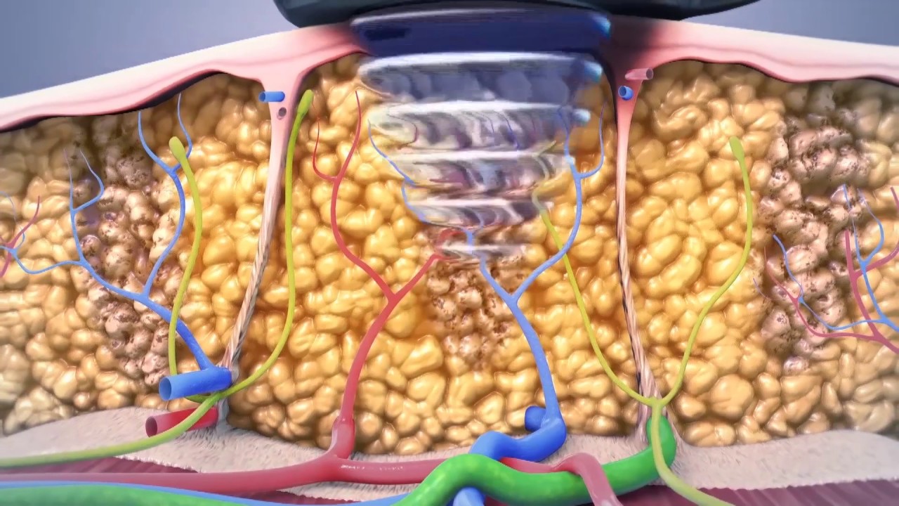 UltraShape Power: Fat Reduction in Orlando