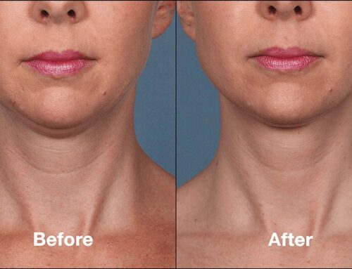 KYBELLA™ (deoxycholic acid)